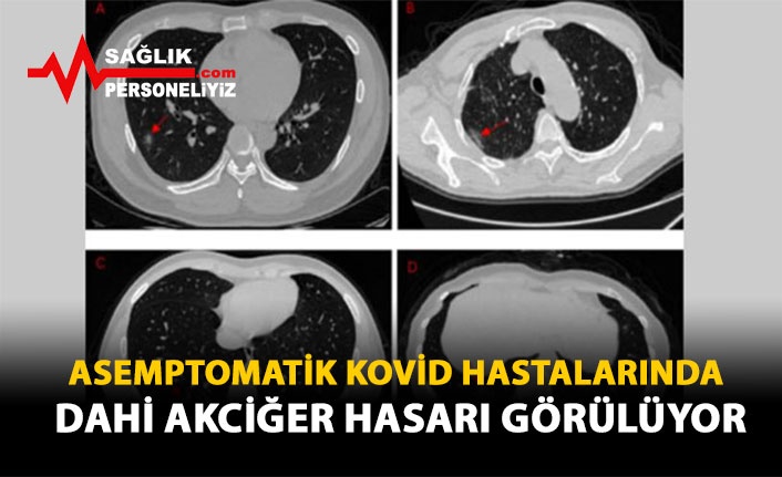 Asemptomatik Kovid Hastalarında Dahi Akciğer Hasarı Görülüyor